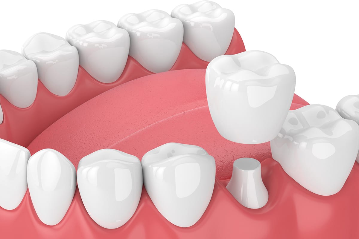 How Much Does A Dental Crown Cost in Ellicott City, MD?