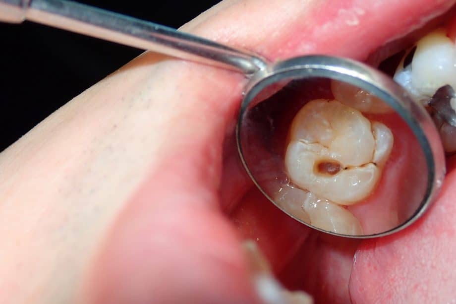 How Long Should a Tooth Hurt After a Filling?
