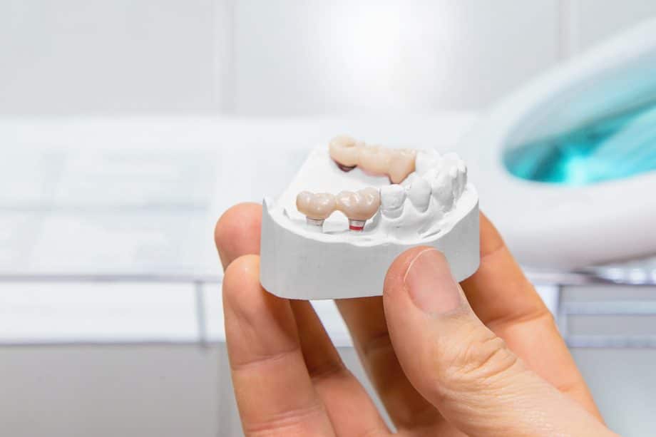 How Much Does A Dental Bridge Cost In Ellicott City, MD?