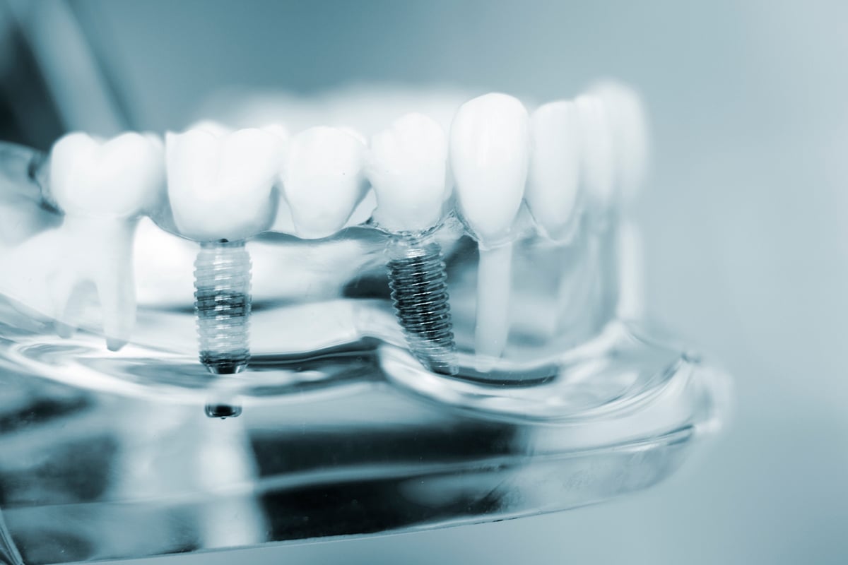 How to Find the Best Dental Implant Dentist in the Baltimore Area